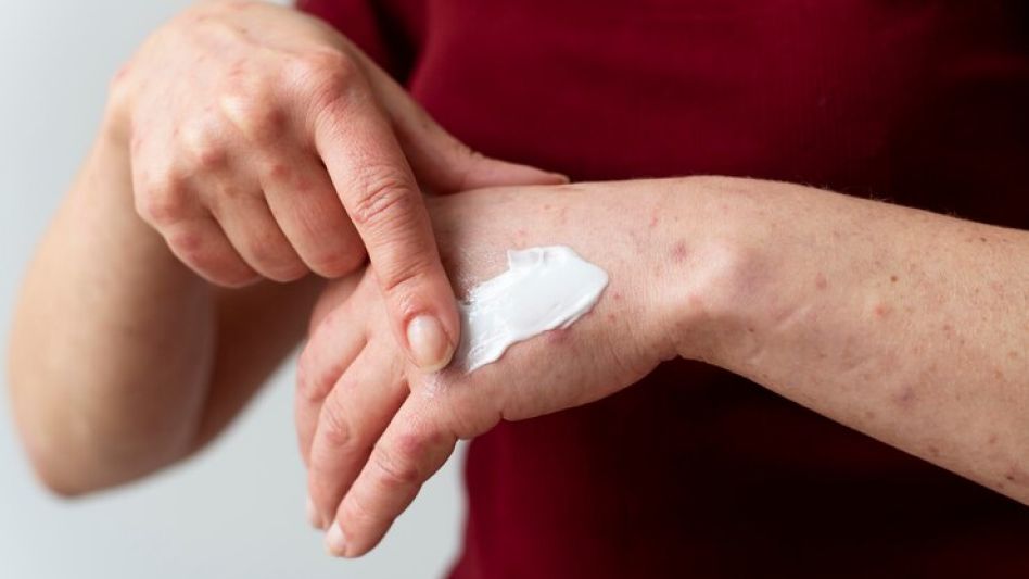 DERMATITIS ATÓPICA: TODO LO QUE NECESITAS SABER ACERCA DE ESTA AFECCIÓN